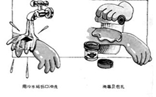 烫伤水泡怎么处理